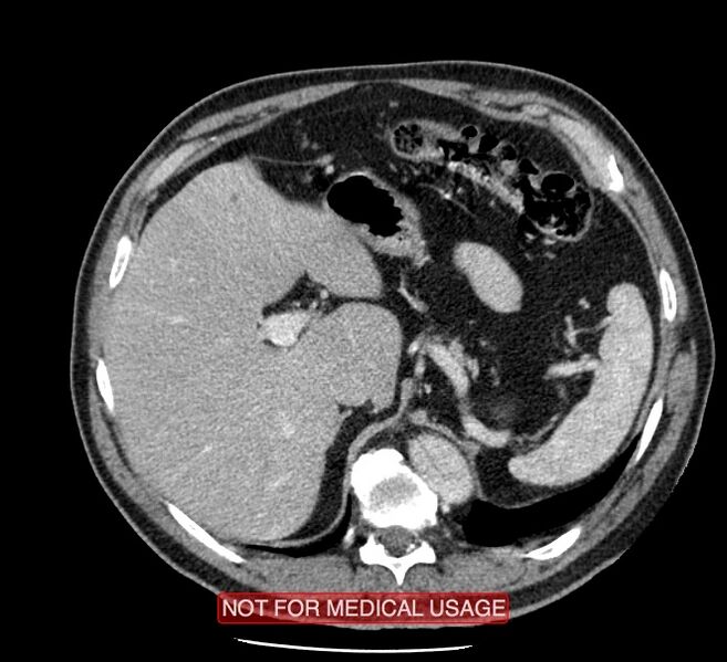 File:Acute aortic dissection - Stanford type A (Radiopaedia 40661-43285 Axial C+ portal venous phase 68).jpg