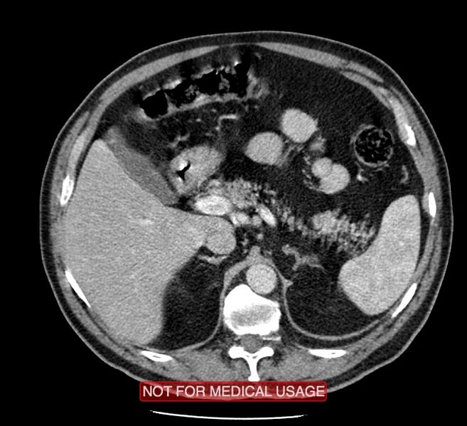 File:Acute aortic dissection - Stanford type A (Radiopaedia 40661-43285 Axial C+ portal venous phase 80).jpg