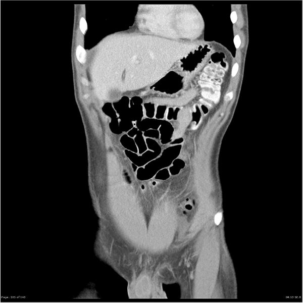 File:Acute appendicitis (Radiopaedia 25364-25615 C+ portal venous phase 2).jpg