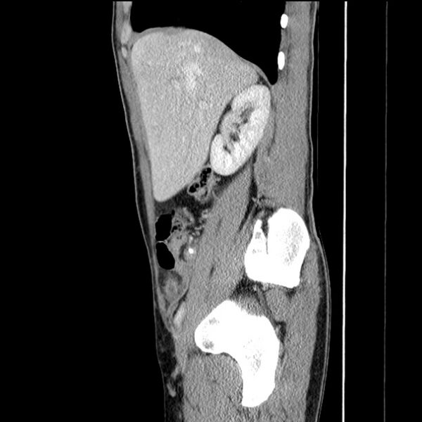 File:Acute appendicitis (Radiopaedia 27049-27227 Sagittal C+ portal venous phase 24).jpg