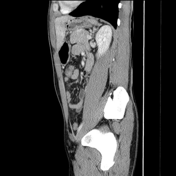 File:Acute appendicitis (Radiopaedia 27049-27227 Sagittal C+ portal venous phase 54).jpg