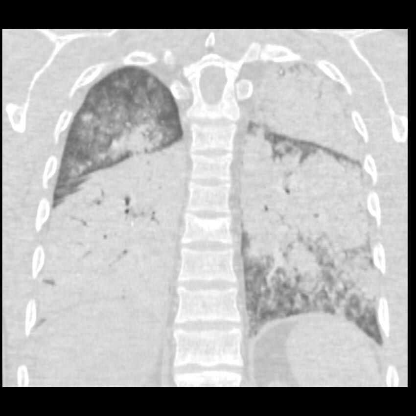 Acute diffuse alveolar hemorrhage (Radiopaedia 41323-44158 Coronal lung window 42).jpg