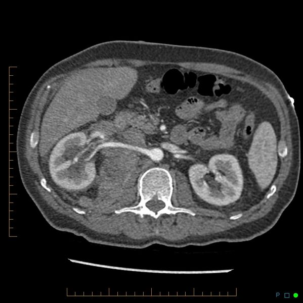 File:Acute hemorrhage into adrenal metastasis from NSCLC (Radiopaedia 43135-46429 Axial C+ arterial phase 11).jpg