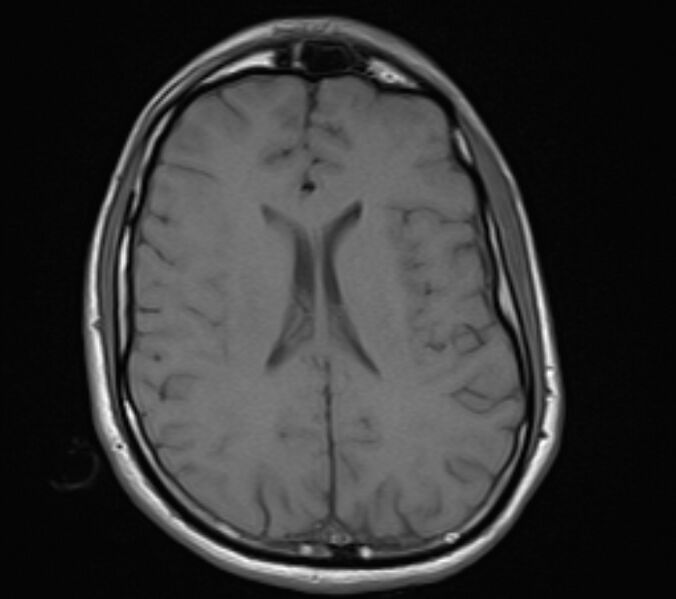 File:Acute ischemic stroke - posterior circulation territory (Radiopaedia 77670-89880 Axial T1 16).jpg