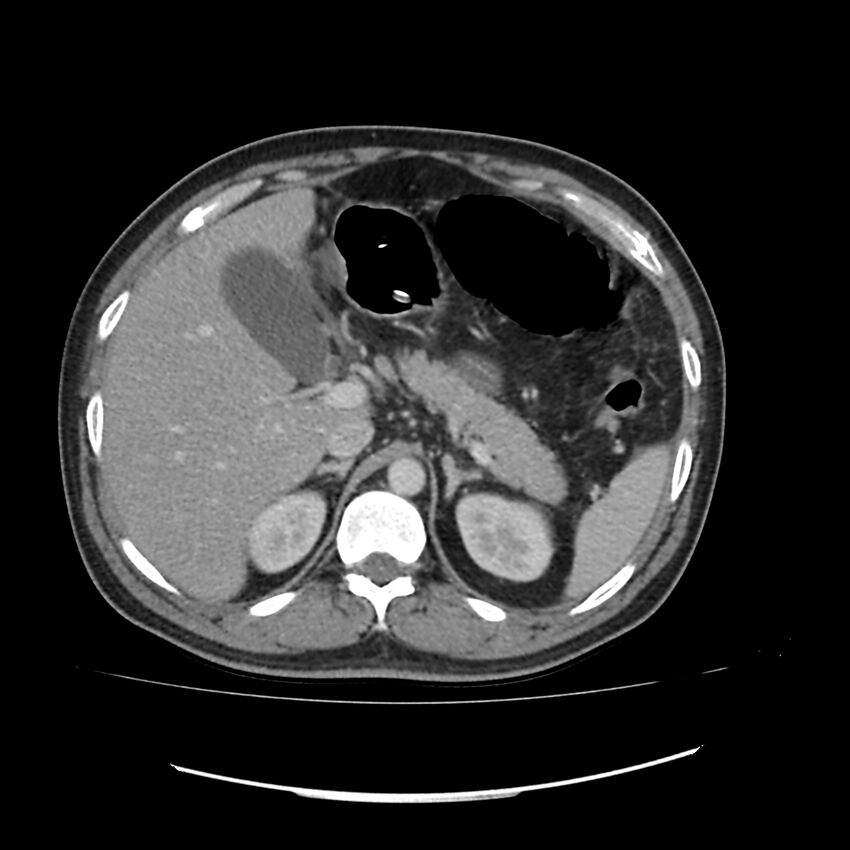 Acute mesenteric ischemia - superior mesenteric artery thrombosis (Radiopaedia 73947-84776 Axial C+ portal venous phase 16).jpg