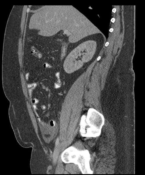 File:Acute mesenteric venous ischemia (Radiopaedia 46041-50383 Sagittal C+ portal venous phase 40).jpg