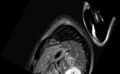 Acute myocarditis (Radiopaedia 77023-88967 Short axis stack LGE 1).jpg