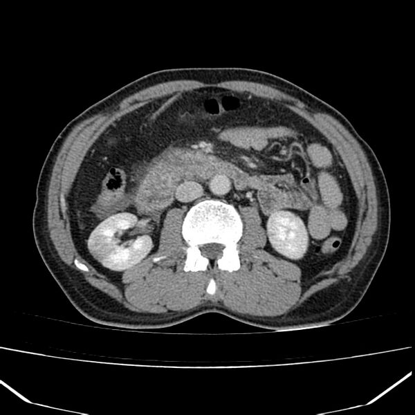 File:Acute pancreatitis (Radiopaedia 22572-22596 Axial C+ portal venous phase 34).jpg