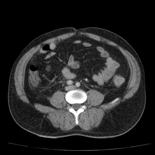 File:Acute pancreatitis (Radiopaedia 26663-26813 Axial C+ portal venous phase 55).jpg