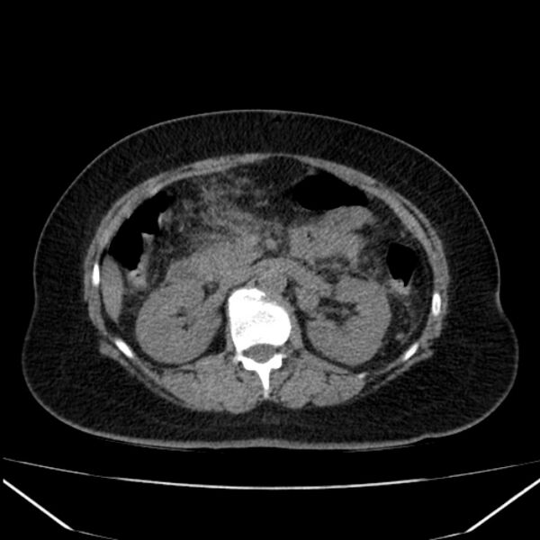 File:Acute pancreatitis - Balthazar C (Radiopaedia 26569-26714 Axial non-contrast 40).jpg