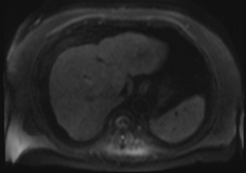 File:Acute portal vein thrombosis (Radiopaedia 73198-83925 Axial DWI 40).jpg