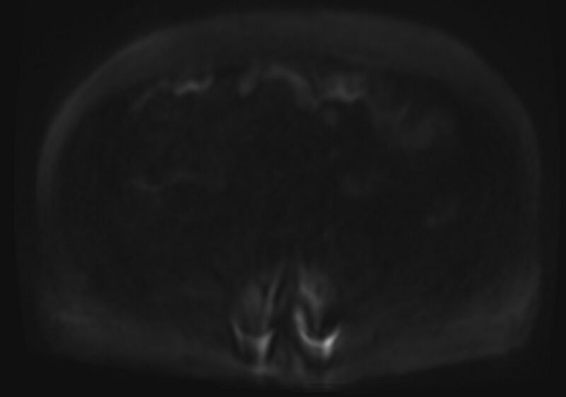 File:Acute portal vein thrombosis (Radiopaedia 73198-83925 Axial DWI 87).jpg
