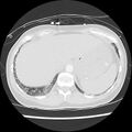 Acute pulmonary edema on CT (Radiopaedia 33582-34672 Axial lung window 49).jpg
