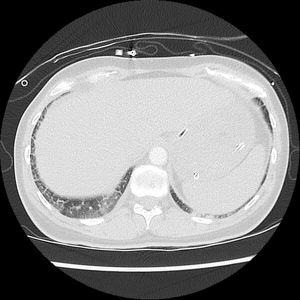 File:Acute pulmonary edema on CT (Radiopaedia 33582-34672 Axial lung window 49).jpg