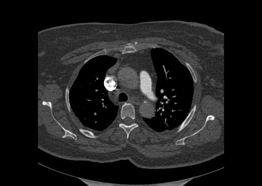 Acute pulmonary embolism (Radiopaedia 29938-30466 Axial C+ CTPA 13).jpg