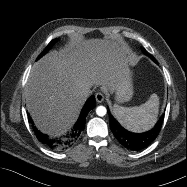 File:Acute pulmonary embolism with pulmonary infarct (Radiopaedia 73062-83768 Axial C+ CTPA 65).jpg