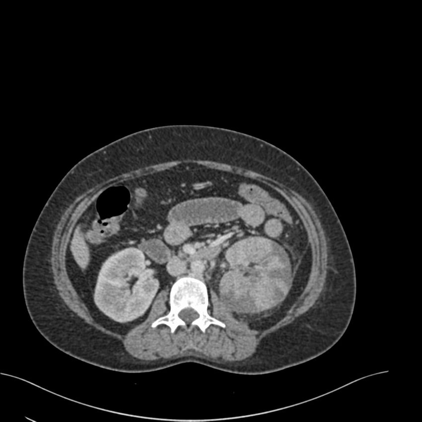 Acute pyelonephritis with renal vein thrombosis (Radiopaedia 58020-65053 Axial renal parenchymal phase 70).jpg