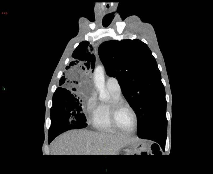 File:Acute right lung abscess (Radiopaedia 34806-36258 Coronal C+ arterial phase 42).jpg