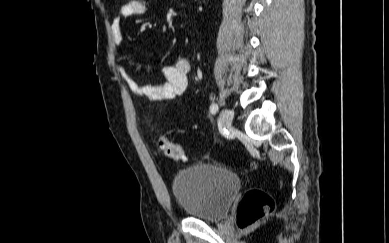 File:Acute sigmoid colon diverticulitis (Radiopaedia 55507-61976 Sagittal C+ portal venous phase 28).jpg