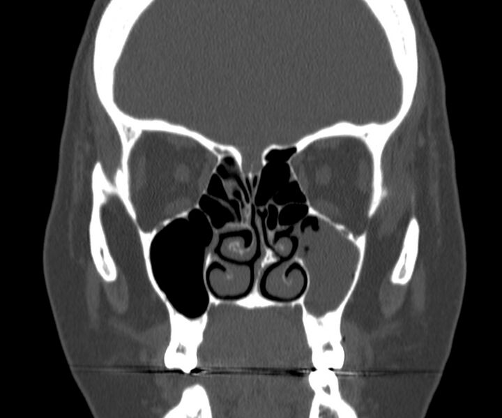File:Acute sinusitis (Radiopaedia 22419-22455 Coronal bone window 18).jpg