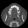 Acute sinusitis (Radiopaedia 23161-23215 Axial bone window 4).jpg