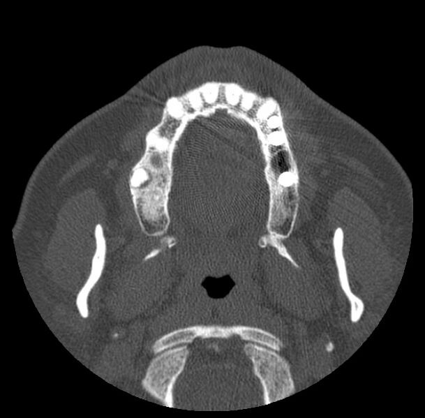 File:Acute sinusitis (Radiopaedia 23161-23215 Axial bone window 4).jpg
