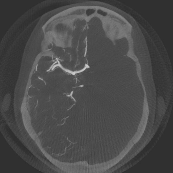 File:Acute subarachnoid hemorrhage and accessory anterior cerebral artery (Radiopaedia 69231-79010 Axial arterial - MIP 31).jpg