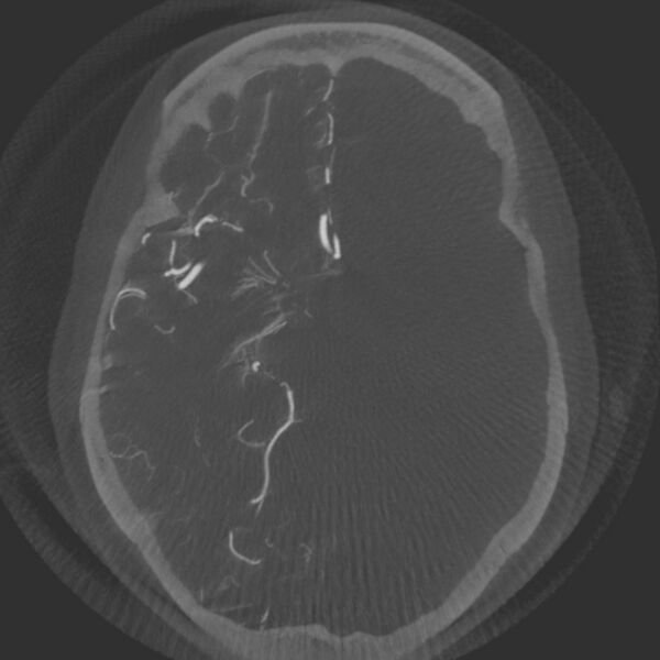 File:Acute subarachnoid hemorrhage and accessory anterior cerebral artery (Radiopaedia 69231-79010 Axial arterial - MIP 34).jpg