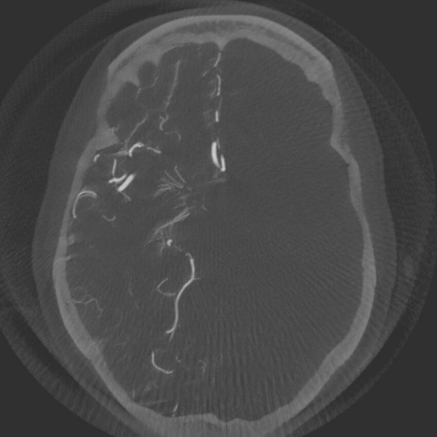 Acute subarachnoid hemorrhage and accessory anterior cerebral artery (Radiopaedia 69231-79010 Axial arterial - MIP 34).jpg