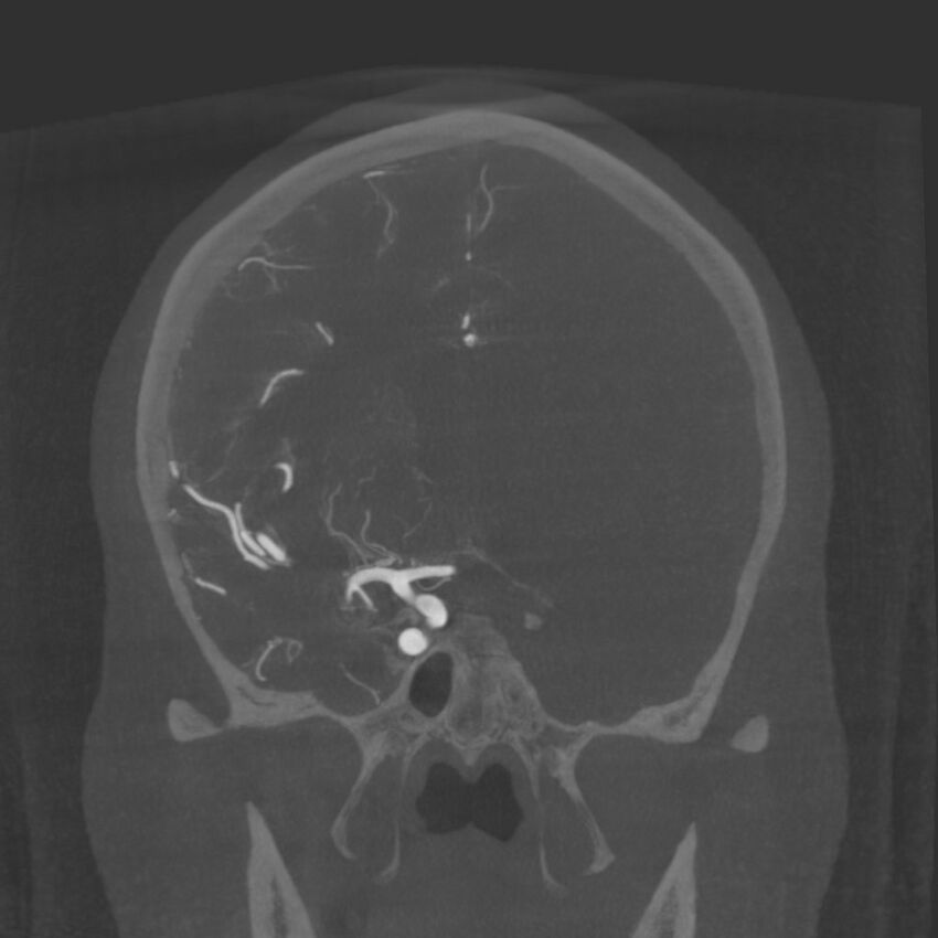 Acute subarachnoid hemorrhage and accessory anterior cerebral artery (Radiopaedia 69231-79010 Coronal arterial - MIP 43).jpg