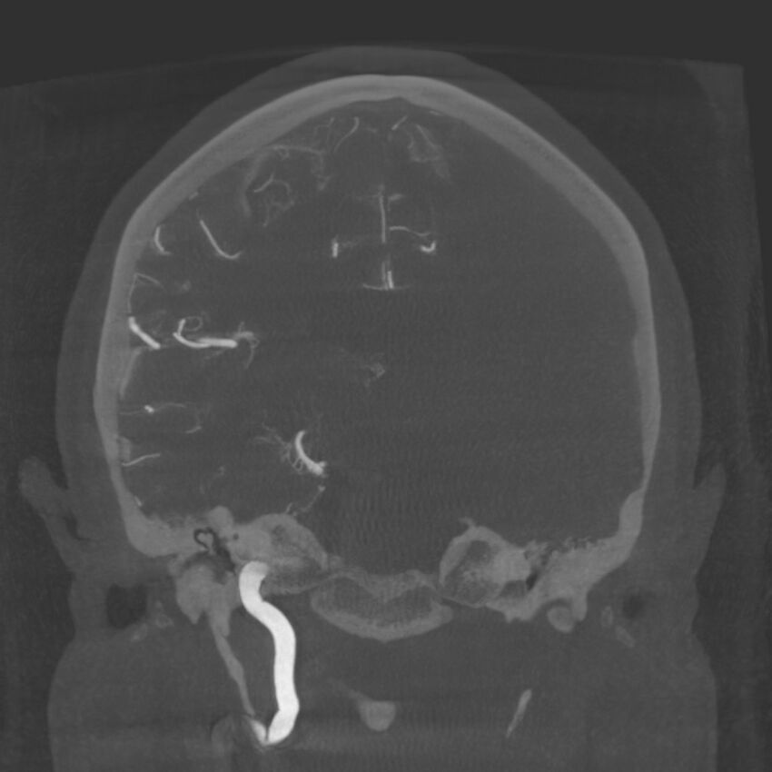 Acute subarachnoid hemorrhage and accessory anterior cerebral artery (Radiopaedia 69231-79010 Coronal arterial - MIP 59).jpg