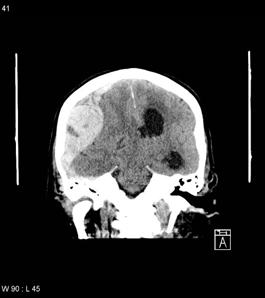 File:Acute subdural hematoma with myelofibrosis (Radiopaedia 52582-58494 Coronal non-contrast 32).jpg
