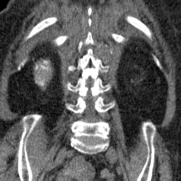 File:Acute tubular necrosis (Radiopaedia 28077-28334 Coronal non-contrast 30).jpg