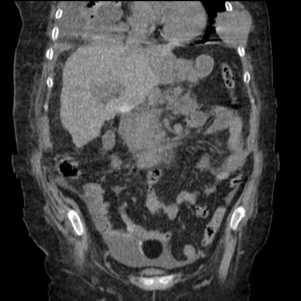 File:Acute tubular necrosis (Radiopaedia 28077-28334 G 38).jpg