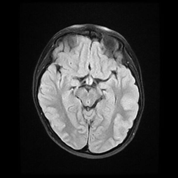 File:Adamantinomatous craniopharyngioma (Radiopaedia 77407-89529 Axial FLAIR 11).jpg