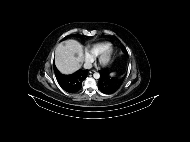 File:Adenocarcinoma of pancreas with hepatic metastasis (Radiopaedia 64332-73122 Axial C+ portal venous phase 14).jpg