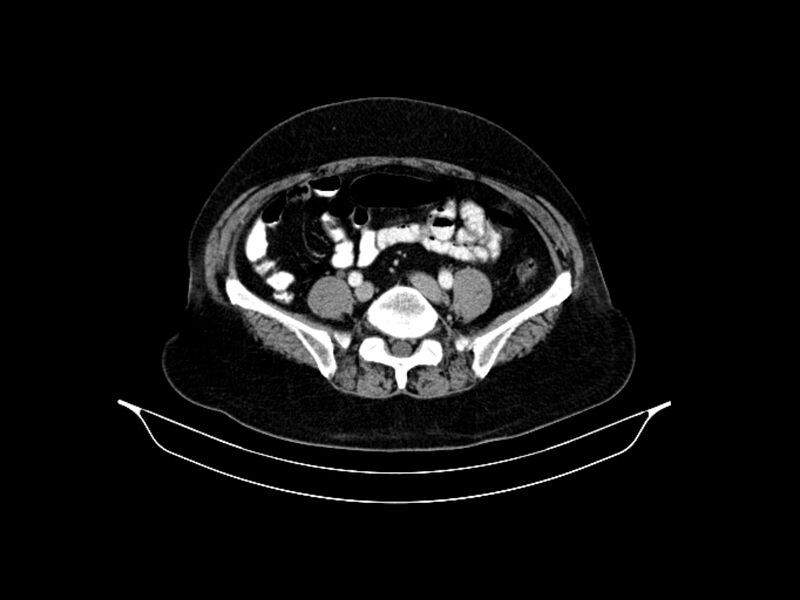 File:Adenocarcinoma of pancreas with hepatic metastasis (Radiopaedia 64332-73122 Axial C+ portal venous phase 72).jpg