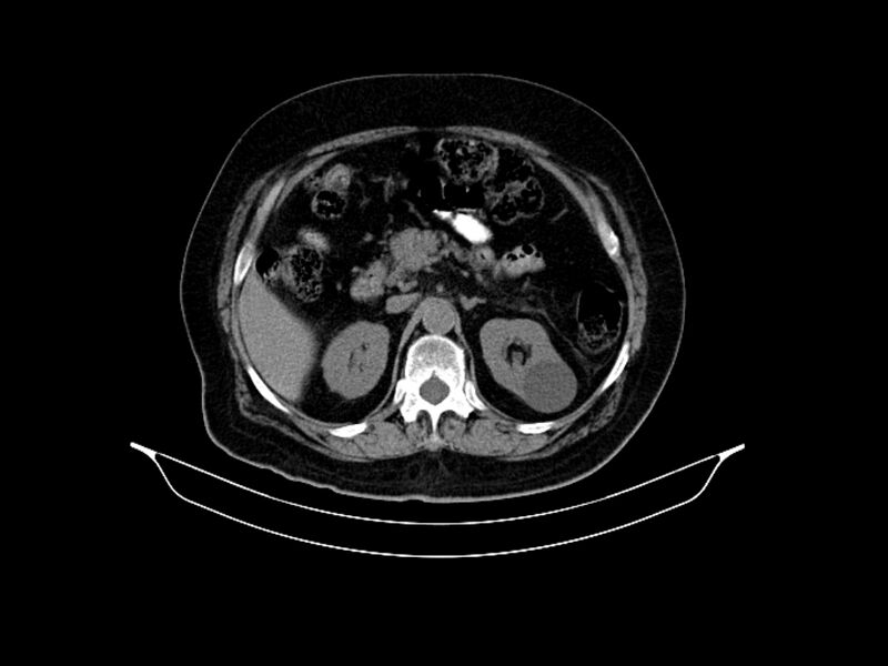 File:Adenocarcinoma of pancreas with hepatic metastasis (Radiopaedia 64332-73122 Axial non-contrast 37).jpg
