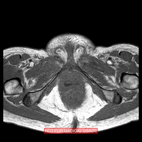 File:Adenocarcinoma of the cervix (Radiopaedia 28373-28615 Axial T1 1).jpg