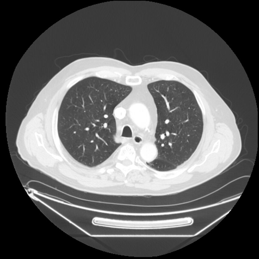 Adenocarcinoma of the lung (Radiopaedia 44876-48759 Axial lung window 26).jpg