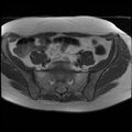 Adenoma malignum of the cervix (Radiopaedia 24460-24765 T1 2).jpg