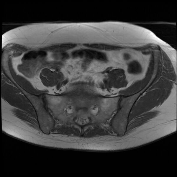 File:Adenoma malignum of the cervix (Radiopaedia 24460-24765 T1 2).jpg