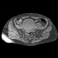 Adenomyoma of the uterus (huge) (Radiopaedia 9870-10438 Axial T1 fat sat 21).jpg