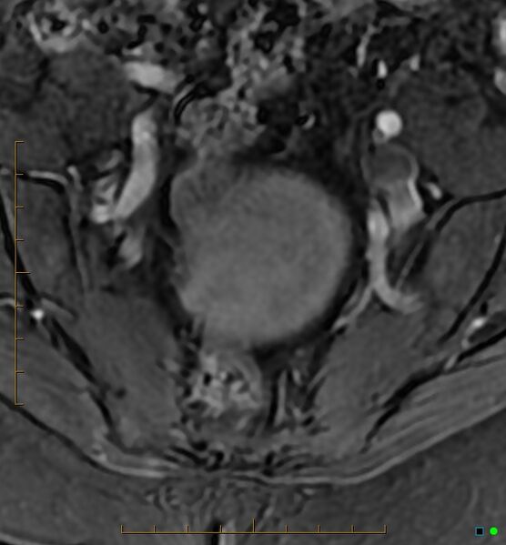 File:Adenomyosis uterus with hematometra (Radiopaedia 45779-50011 Axial T1 C+ fat sat 4).jpg