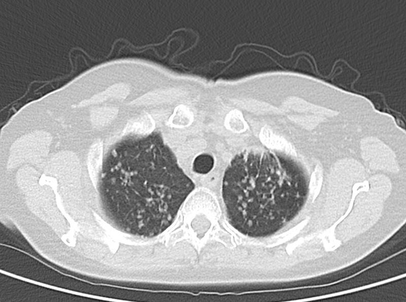 File:Adenosquamous lung carcinoma (Radiopaedia 22035-22030 lung window 17).jpg