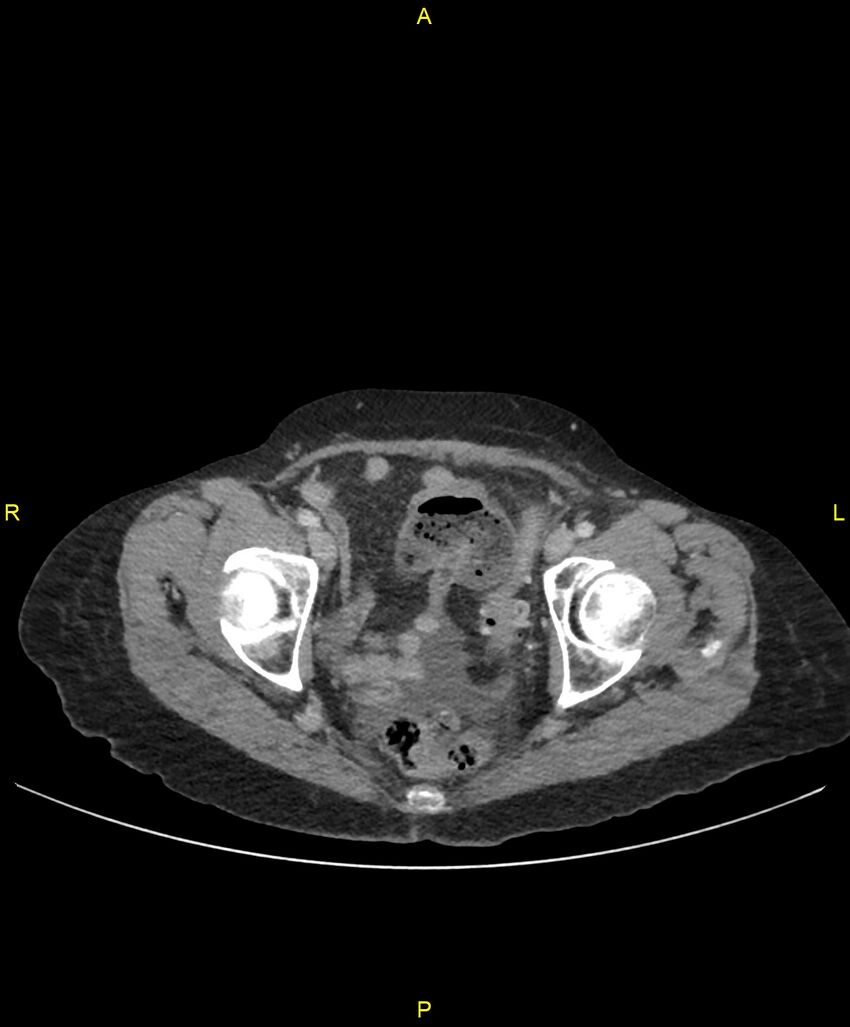 Adhesional small bowel obstruction (Radiopaedia 85402-101024 Axial C+ portal venous phase 260).jpg