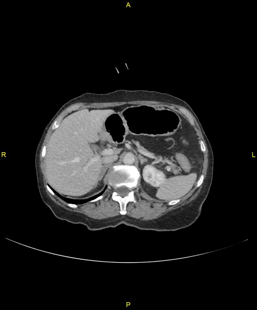 Adhesional small bowel obstruction (Radiopaedia 85402-101024 Axial C+ portal venous phase 78).jpg