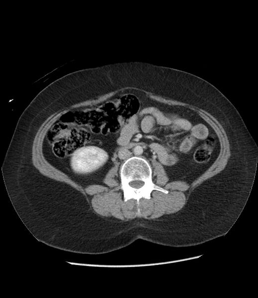 File:Adrenal cortical carcinoma with IVC invasion and thrombosis (Radiopaedia 34307-35597 Axial C+ portal venous phase 47).jpg