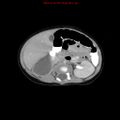 Adrenal hemorrhage (Radiopaedia 9390-10077 Axial C+ portal venous phase 12).jpg