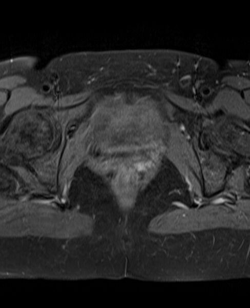 File:Adult granulosa cell tumor of the ovary (Radiopaedia 71581-81950 Axial T1 C+ fat sat 22).jpg